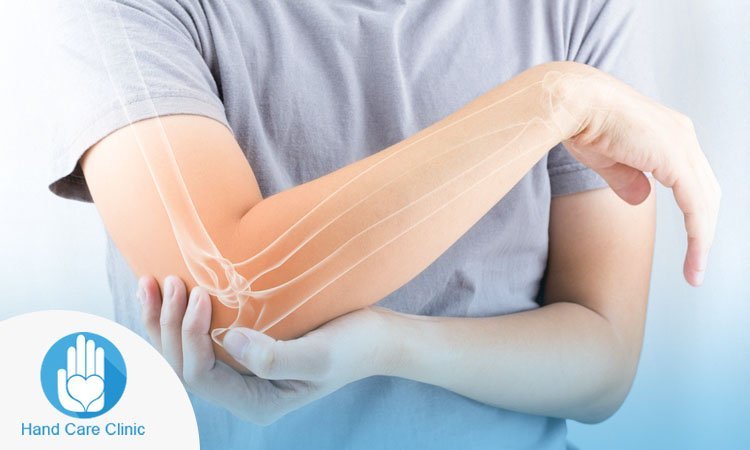 علاج التهاب المفاصل الروماتيزمي