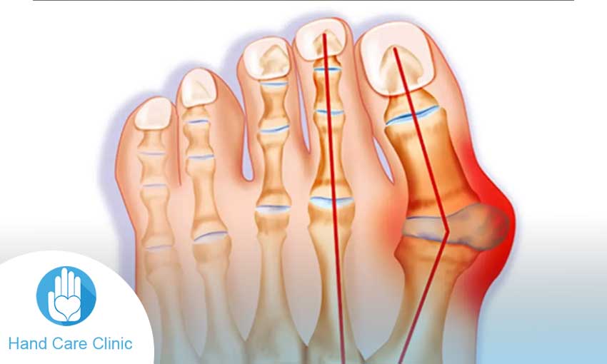علاج بروز العظم الزورقي في القدم
