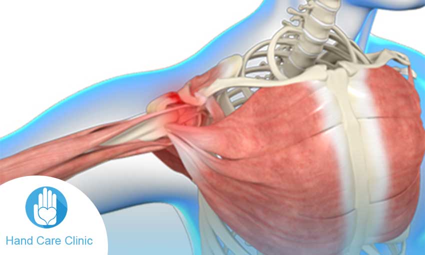 علاج قطع جزئي في وتر الكتف
