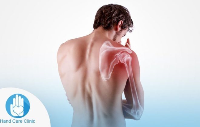 اعراض خلع الكتف