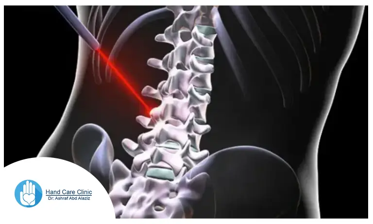 عملية الغضروف بالليزر في مصر