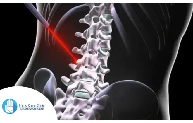 عملية الغضروف بالليزر في مصر