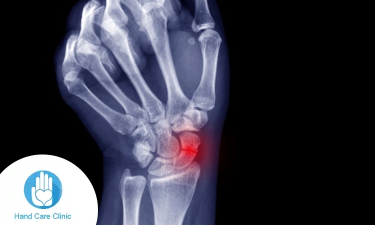 كسر الزورقية