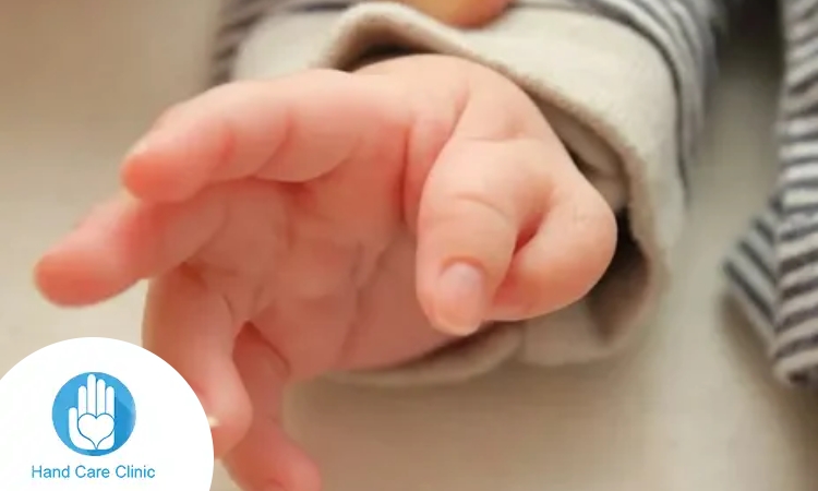 تشوهات اليد عند الاطفال