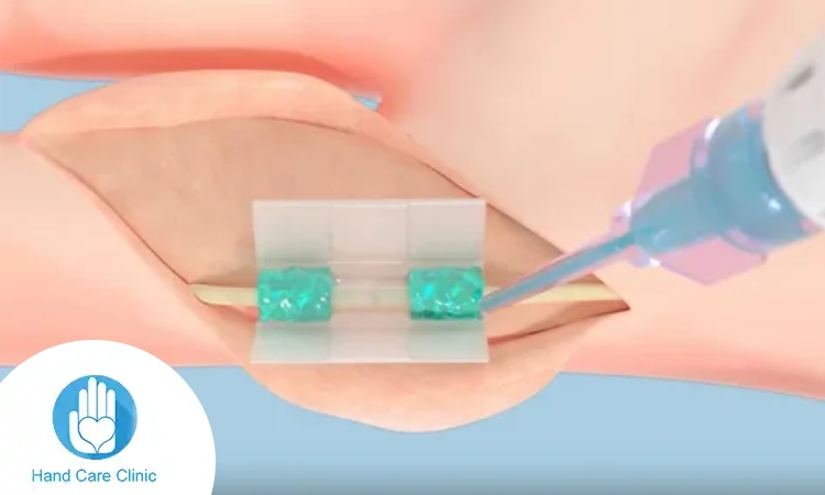 عمليات توصيل الاعصاب