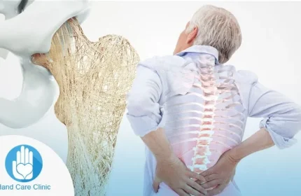 علاج هشاشة العظام