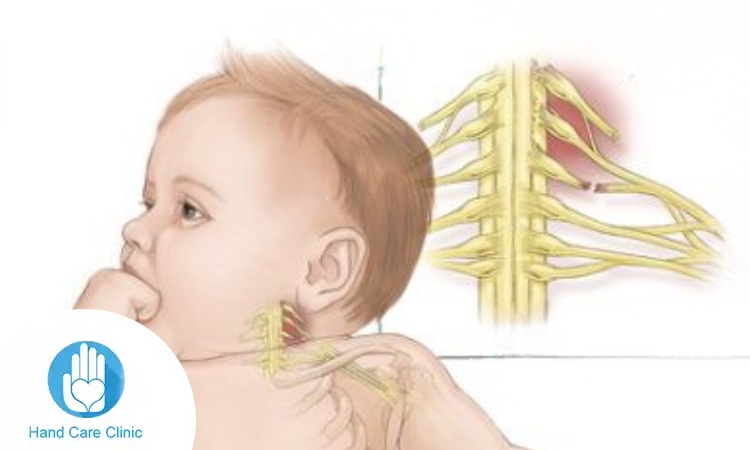 نسبة نجاح عملية الضفيرة العضدية