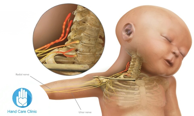 علاج شلل الضفيرة العضدية عند حديثي الولادة