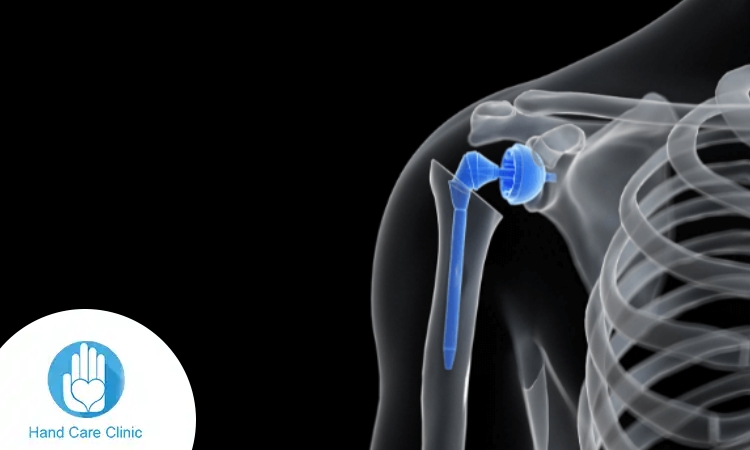 افضل دكتور عظام تخصص كتف