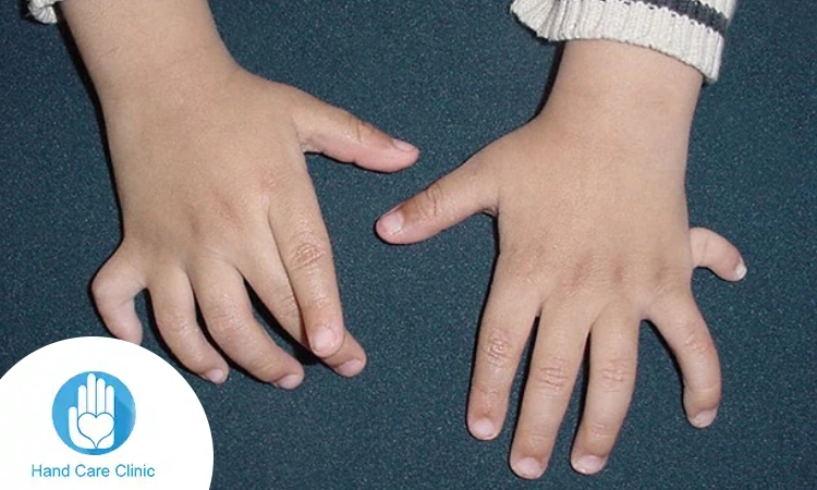 تشوهات أصابع اليد عند الأطفال