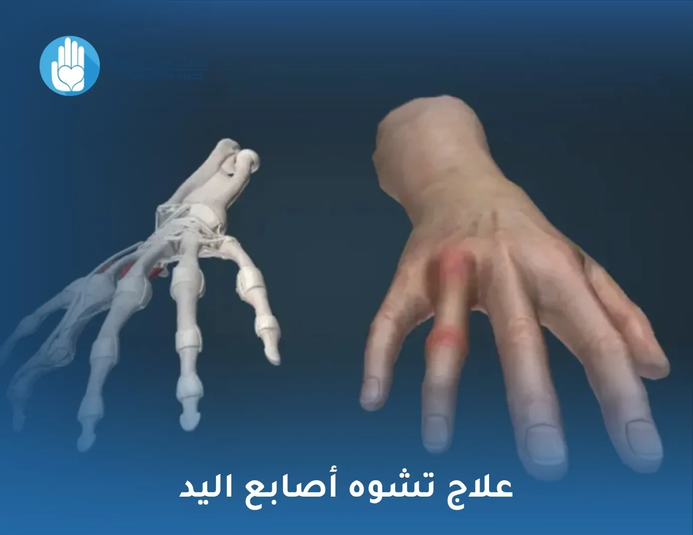 علاج تشوه أصابع اليد