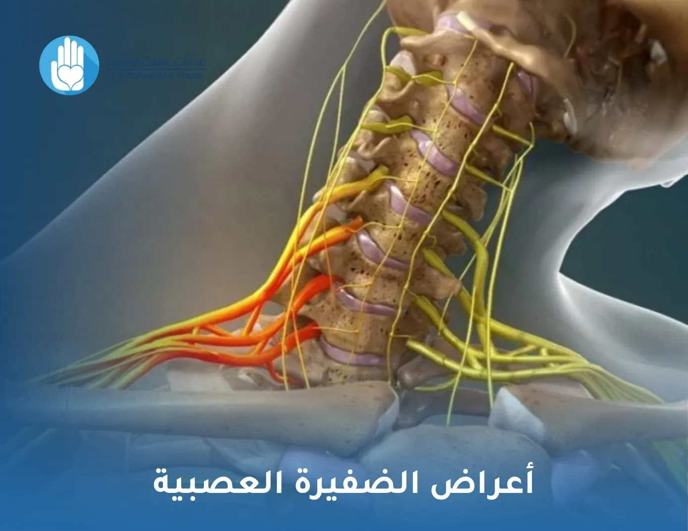 أعراض الضفيرة العصبية
