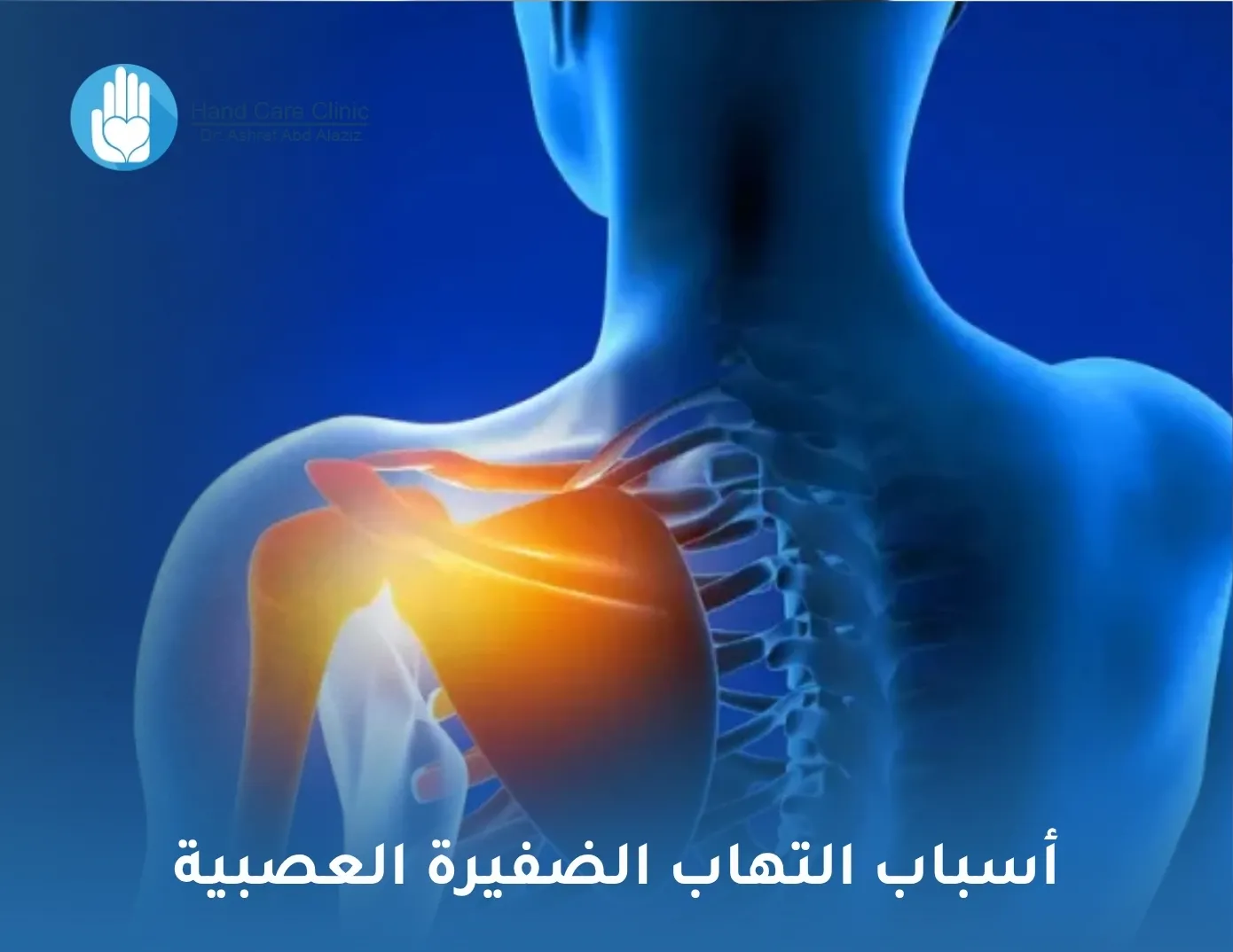 أسباب التهاب الضفيرة العصبية