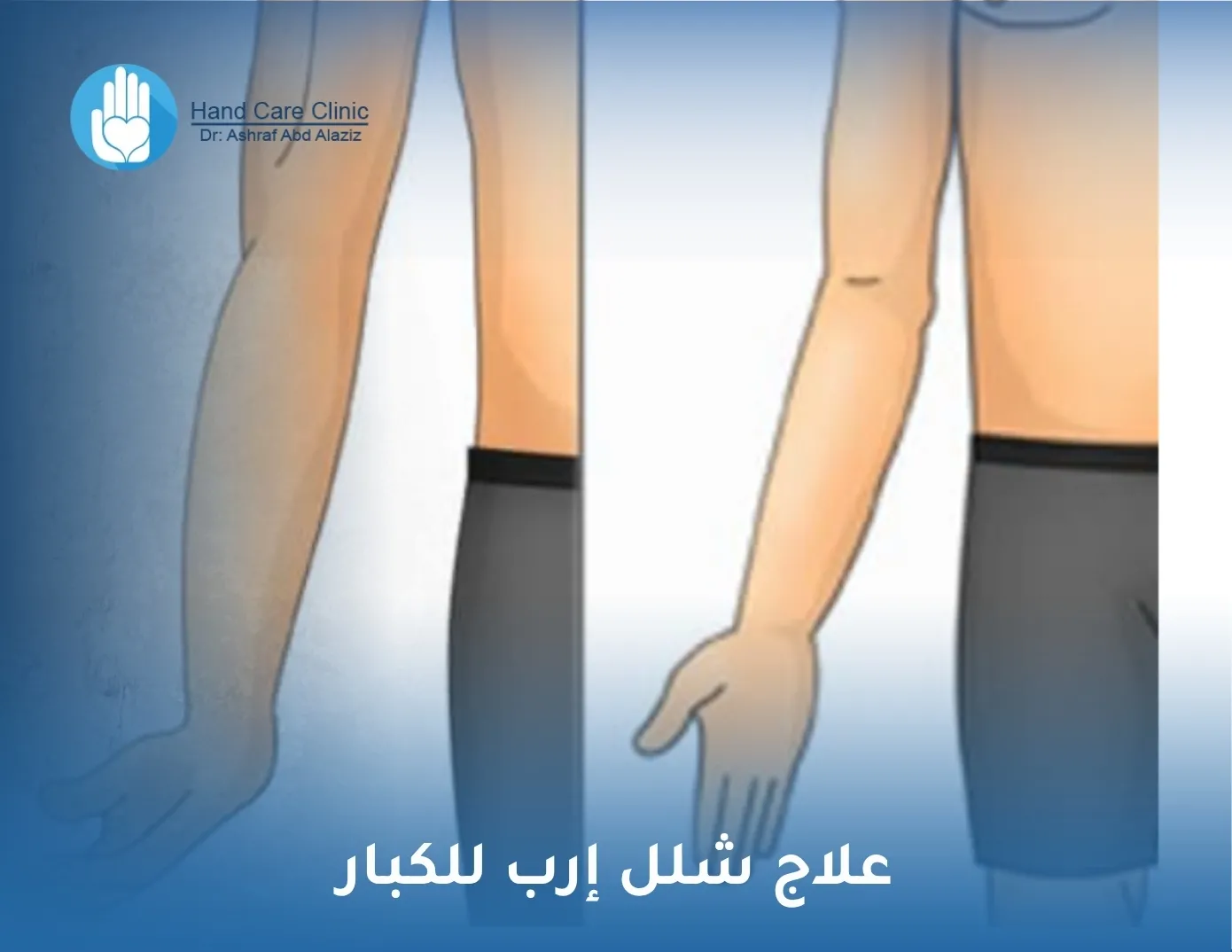علاج شلل إرب للكبار