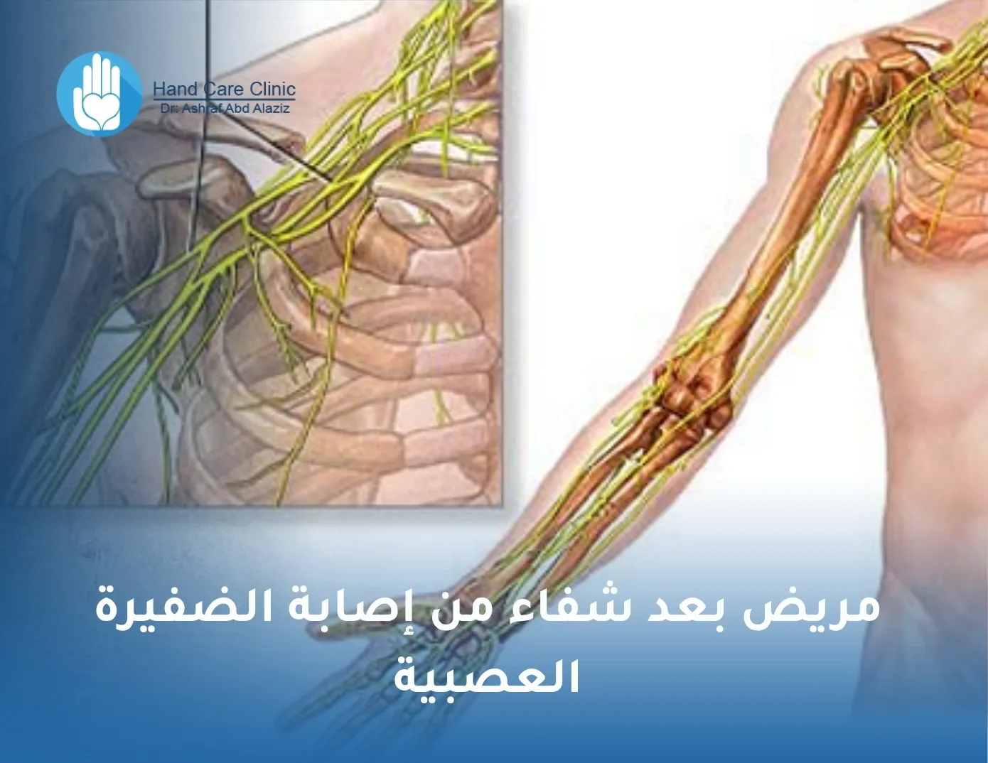 مريض بعد شفاء من إصابة الضفيرة العصبية