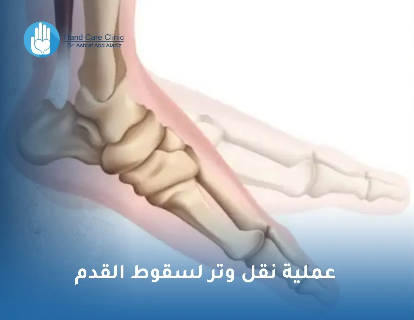 عملية نقل وتر لسقوط القدم