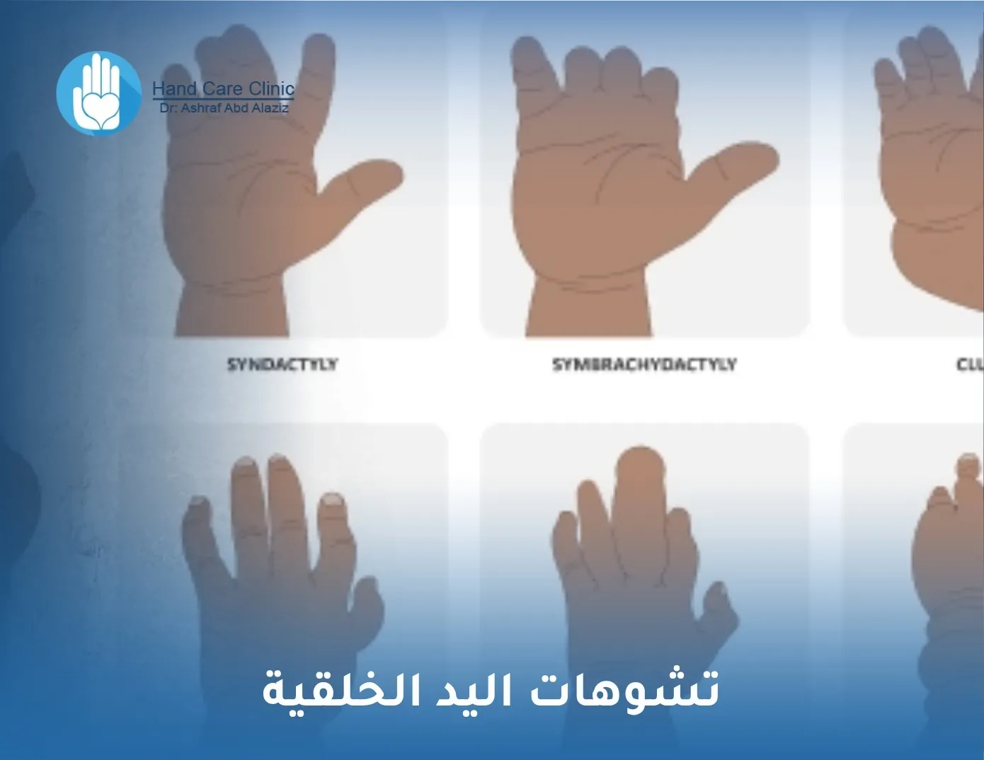 تشوهات اليد الخلقية