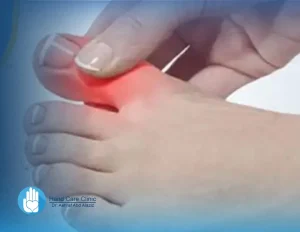 علاج تشنج أصابع القدم