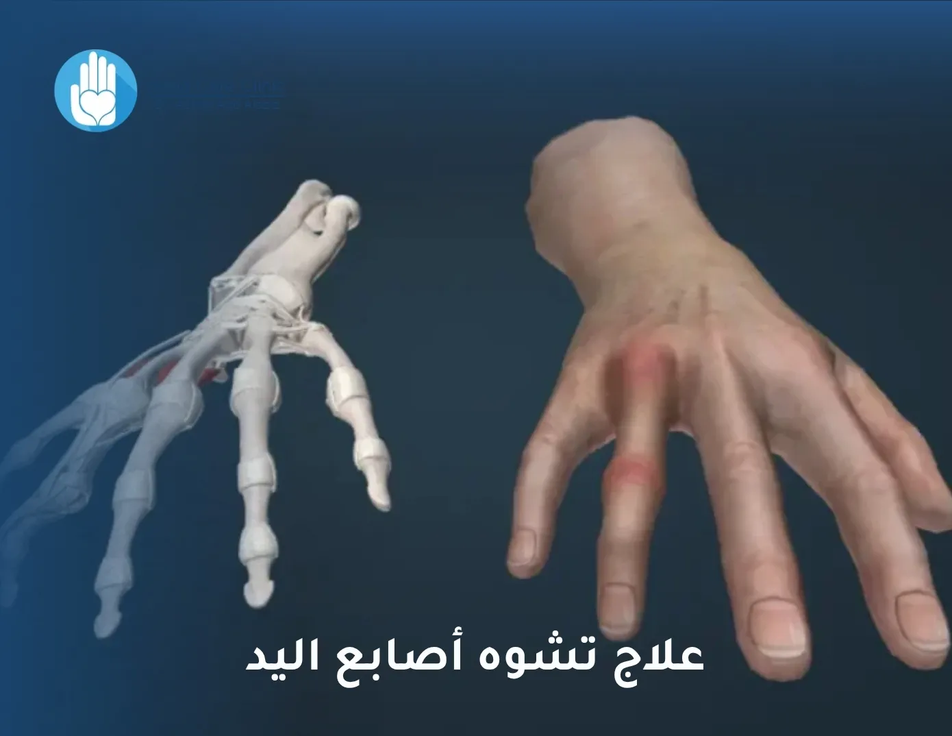 علاج تشوه أصابع اليد
