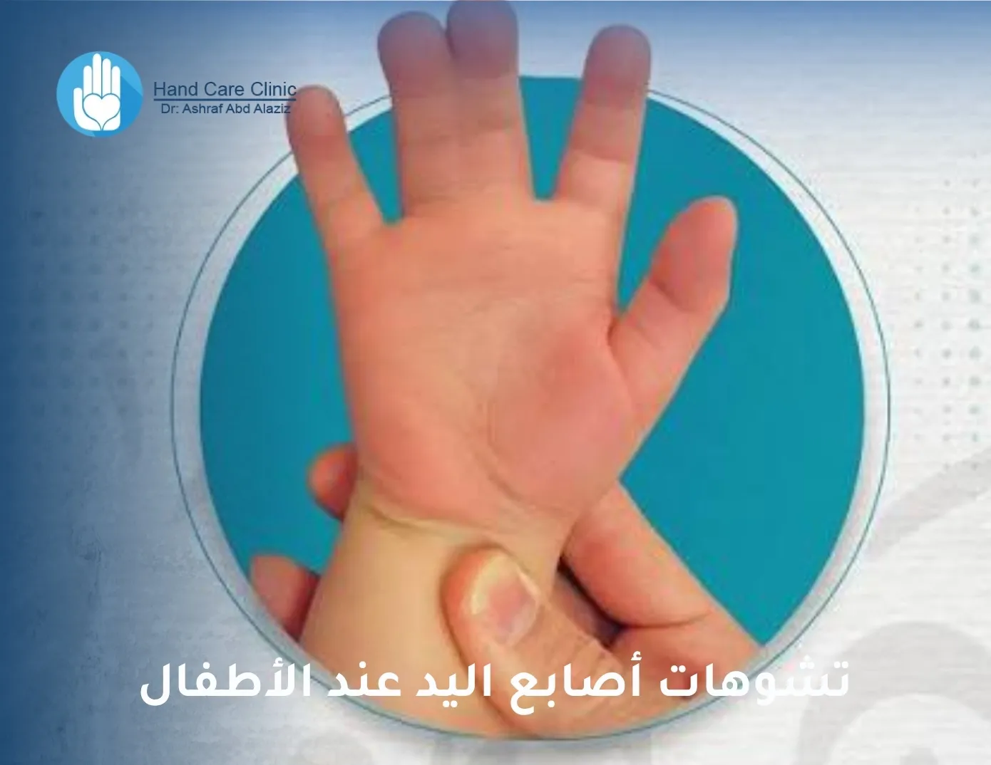 تشوهات أصابع اليد عند الأطفال