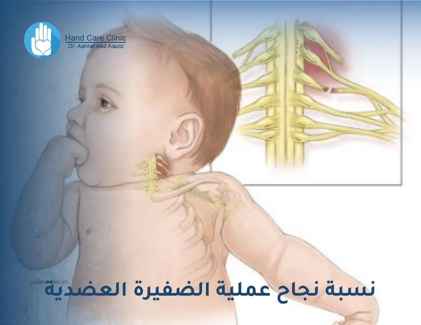 نسبة نجاح عملية الضفيرة العضدية