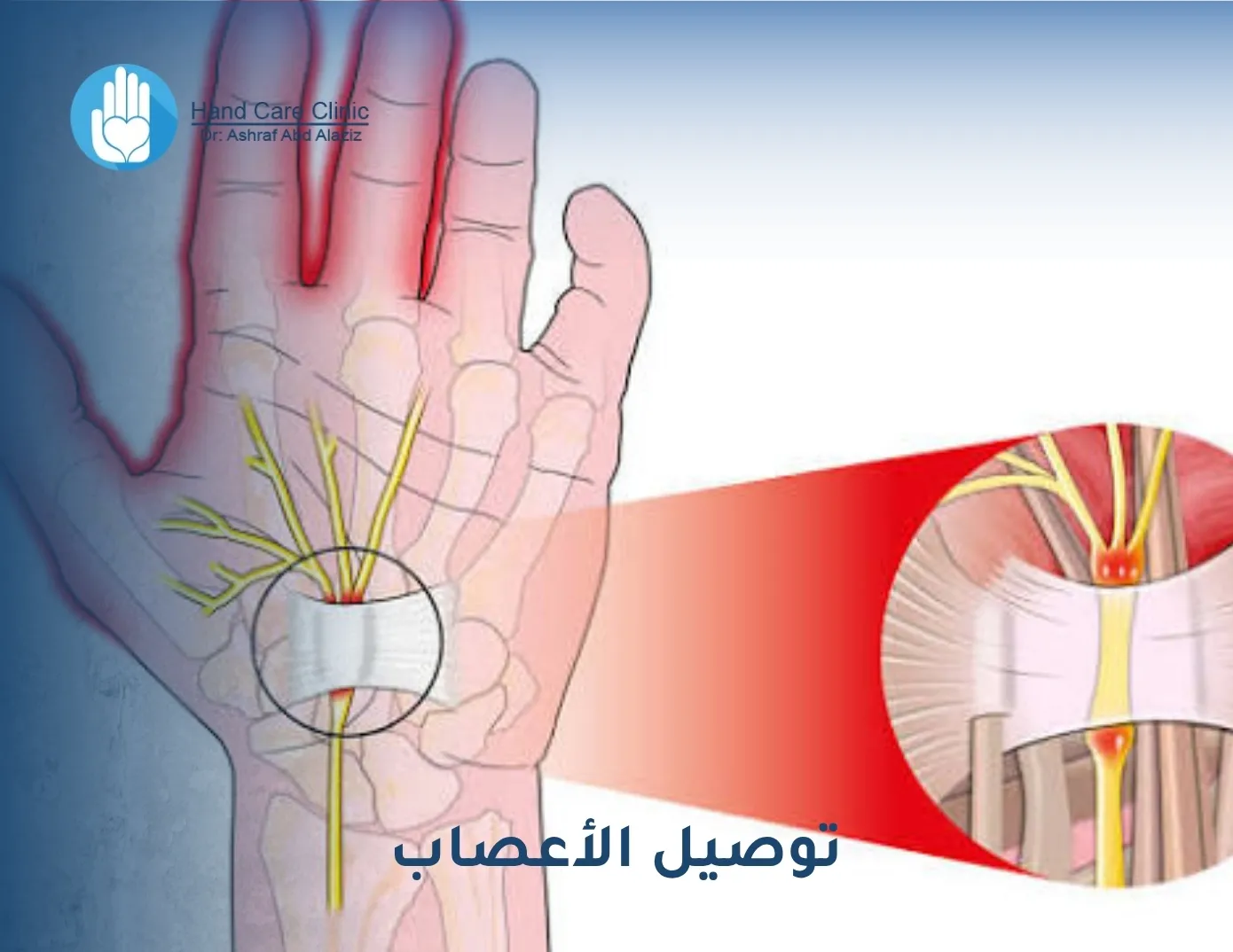 توصيل الأعصاب