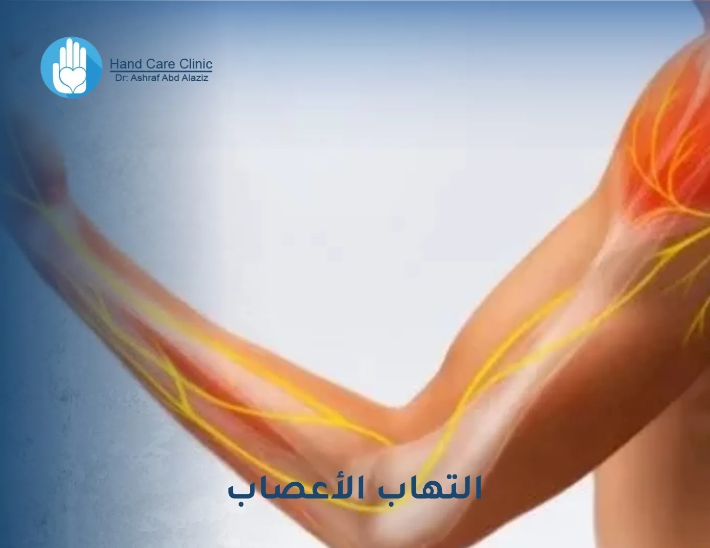 التهاب الأعصاب