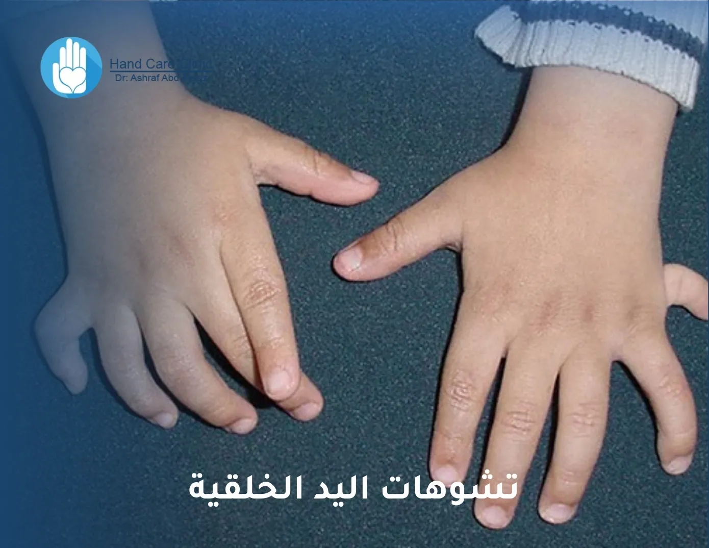 تشوهات اليد الخلقية